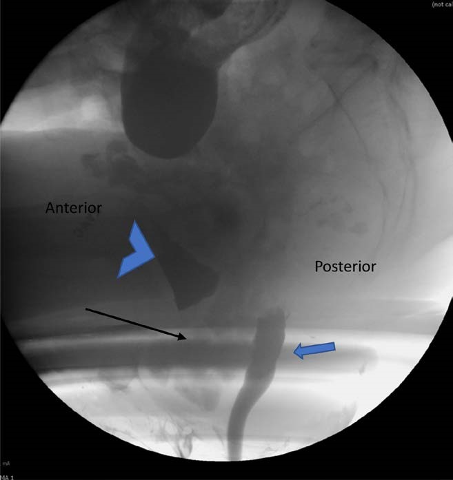 Consensus Definitions and Interpretation Templates for Fluoroscopic ...